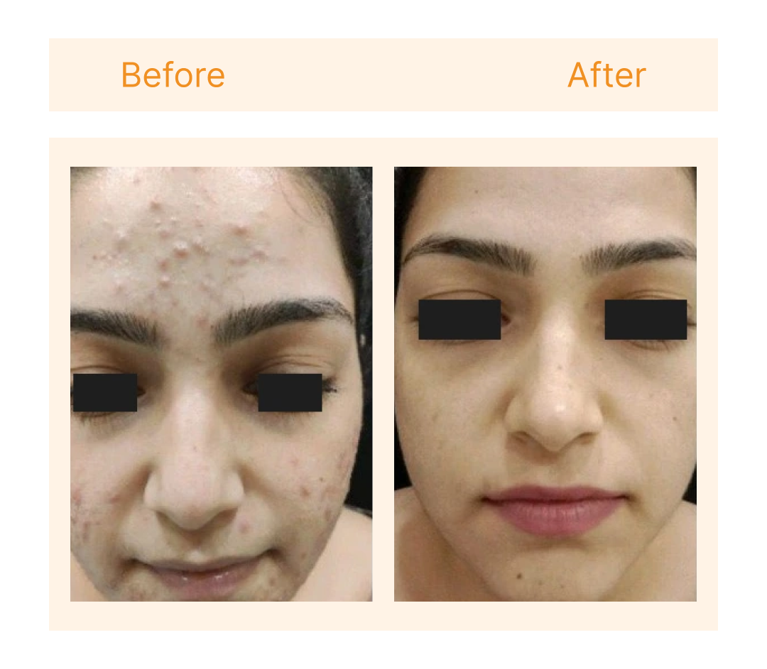 Before and after at SkinLab Ahmedabad