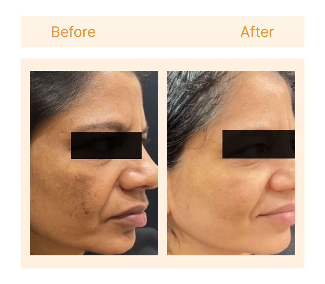 Before and after at SkinLab Ahmedabad