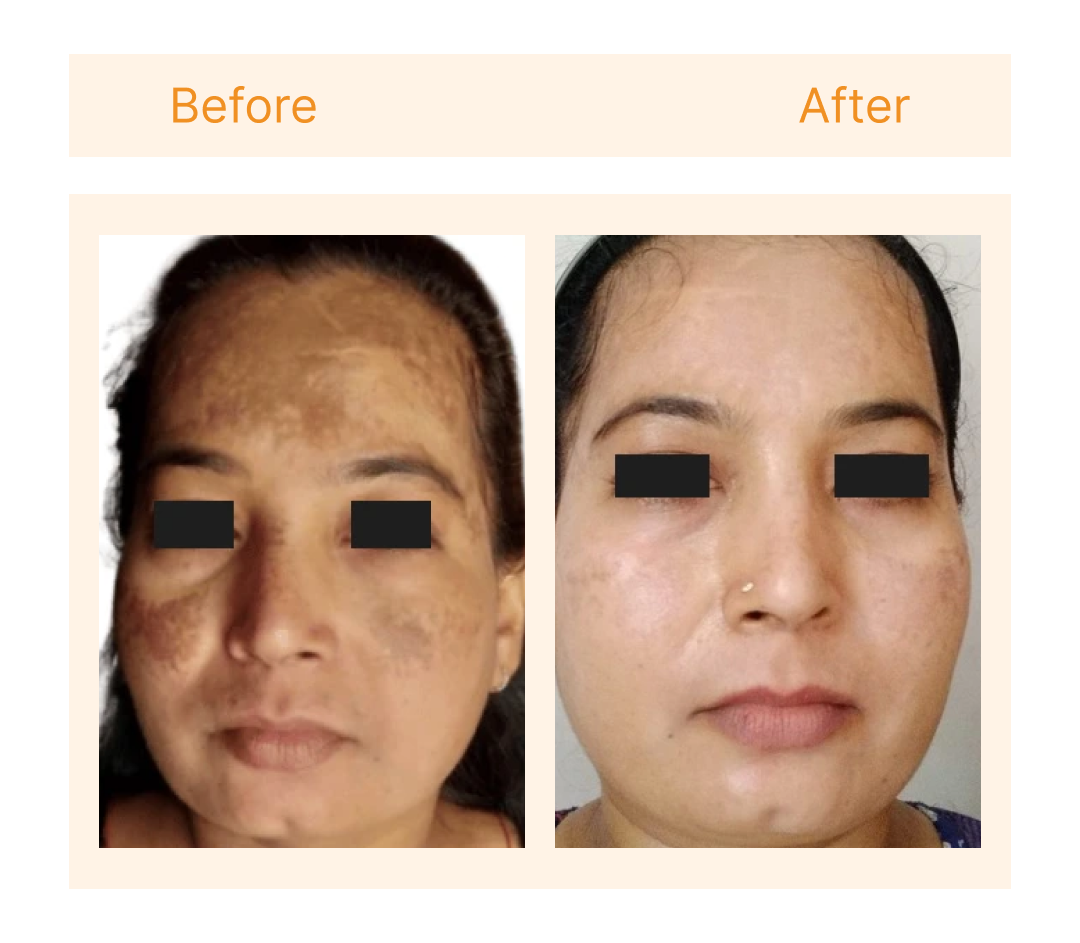 Before and after at SkinLab Ahmedabad